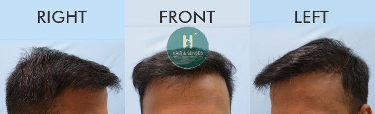 Hair Growth after 10 Months